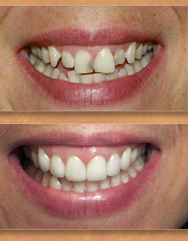 Dentista Broni, Oltrepo Pavese Pulizia Dentale, Impianti Dentali allineamento dentale ortodonzia invisibile