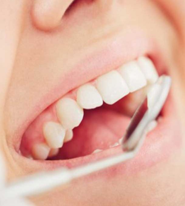 Dentista Casteggio, Oltrepo Pavese Pulizia Dentale, Impianti Dentali